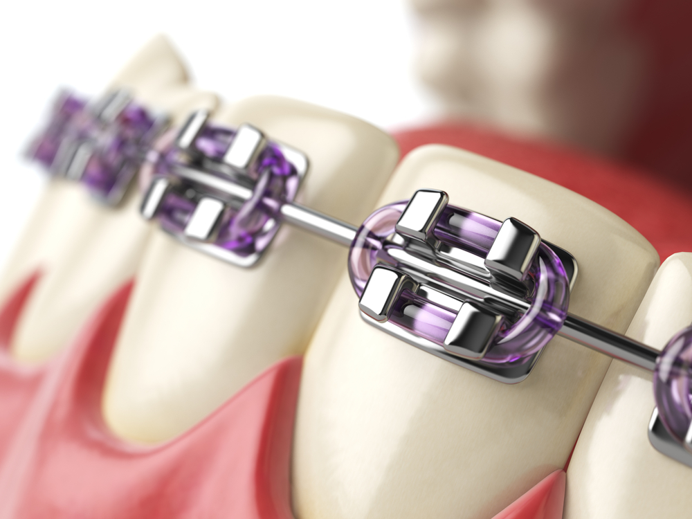 Orthodontic Consumables Market
