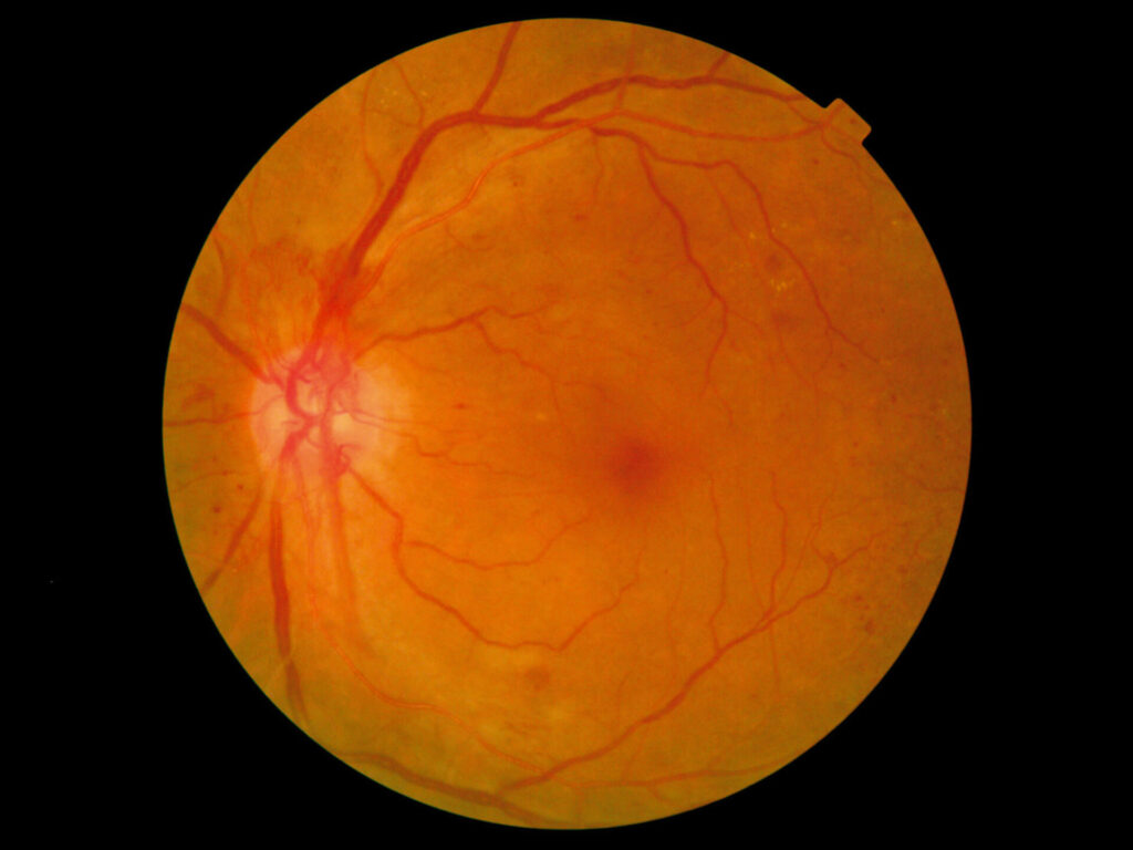 Proliferative Diabetic Retinopathy Market