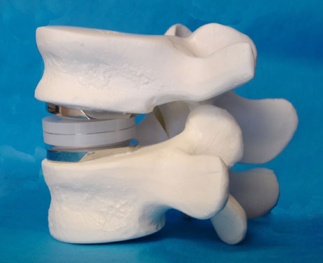 Spinal Implants Material Market