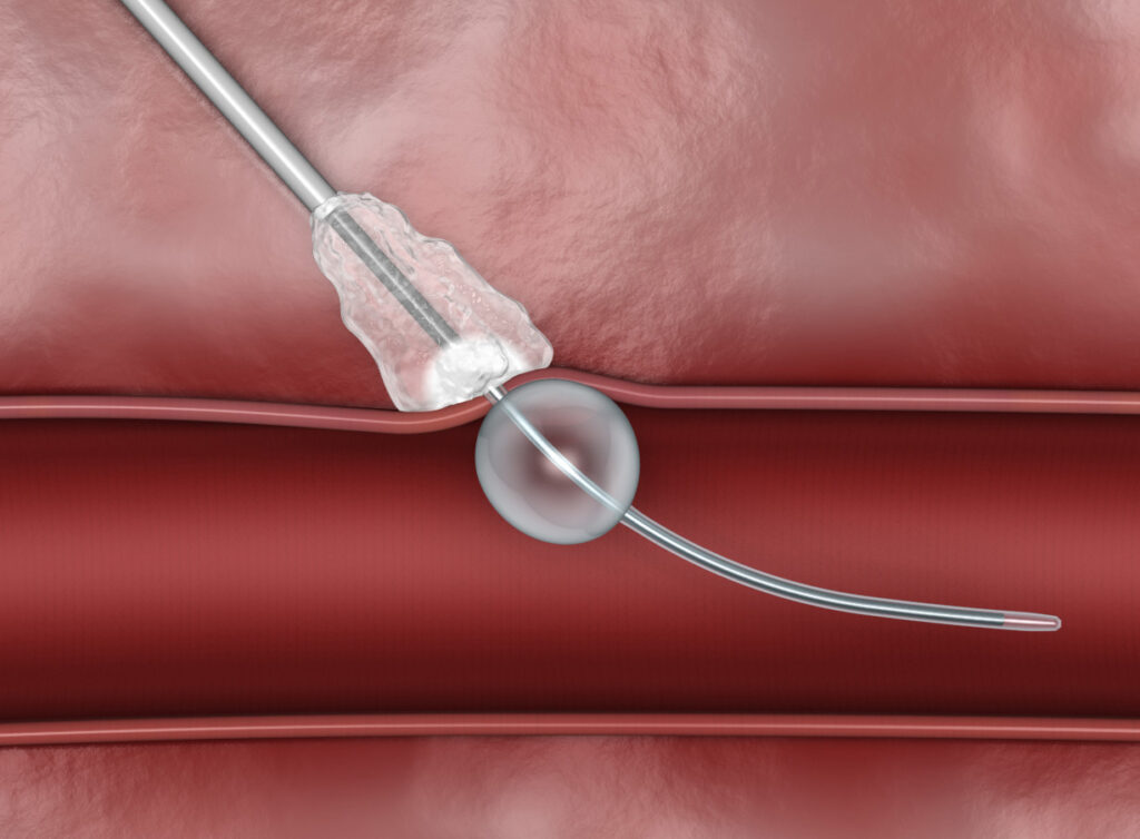 Vascular Closure Systems Market