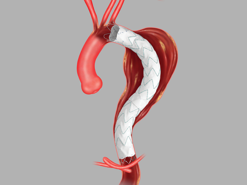 Aortic Stent Grafts Market