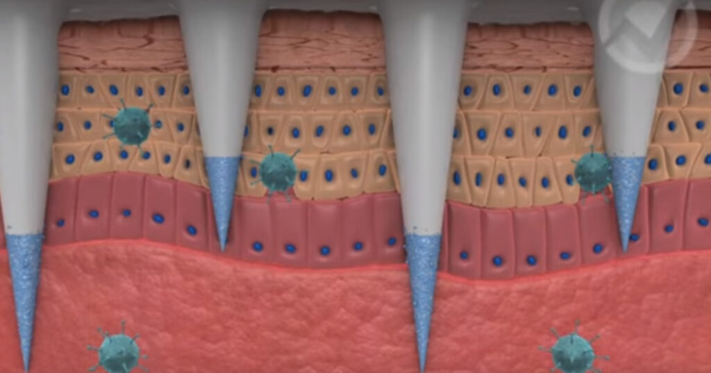 Insoluble Microneedle Patch Market