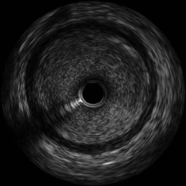Intravascular Ultrasound (IVUS) System Market