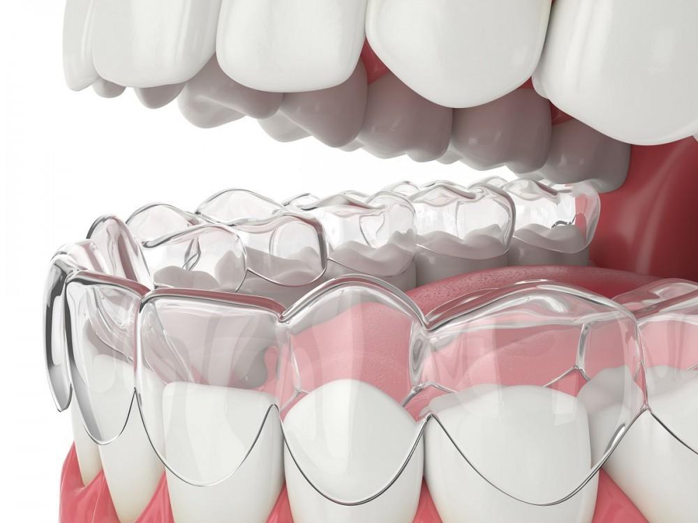Transforming Smiles: The Adult Clear Aligner Market’s Growth and Trends