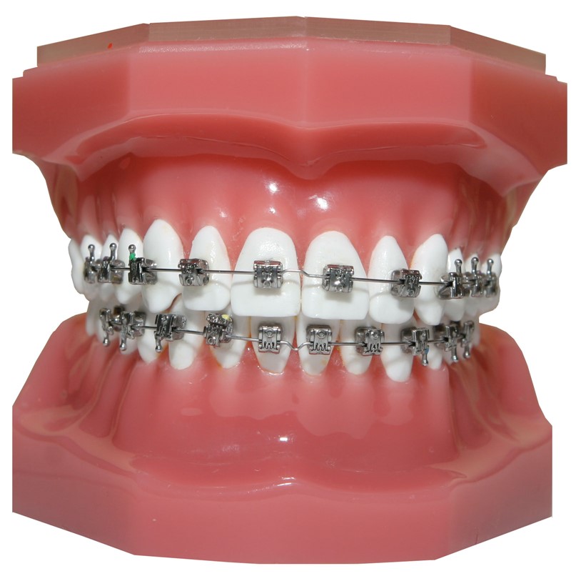 Light-Curable Orthodontic Bracket Adhesives Market