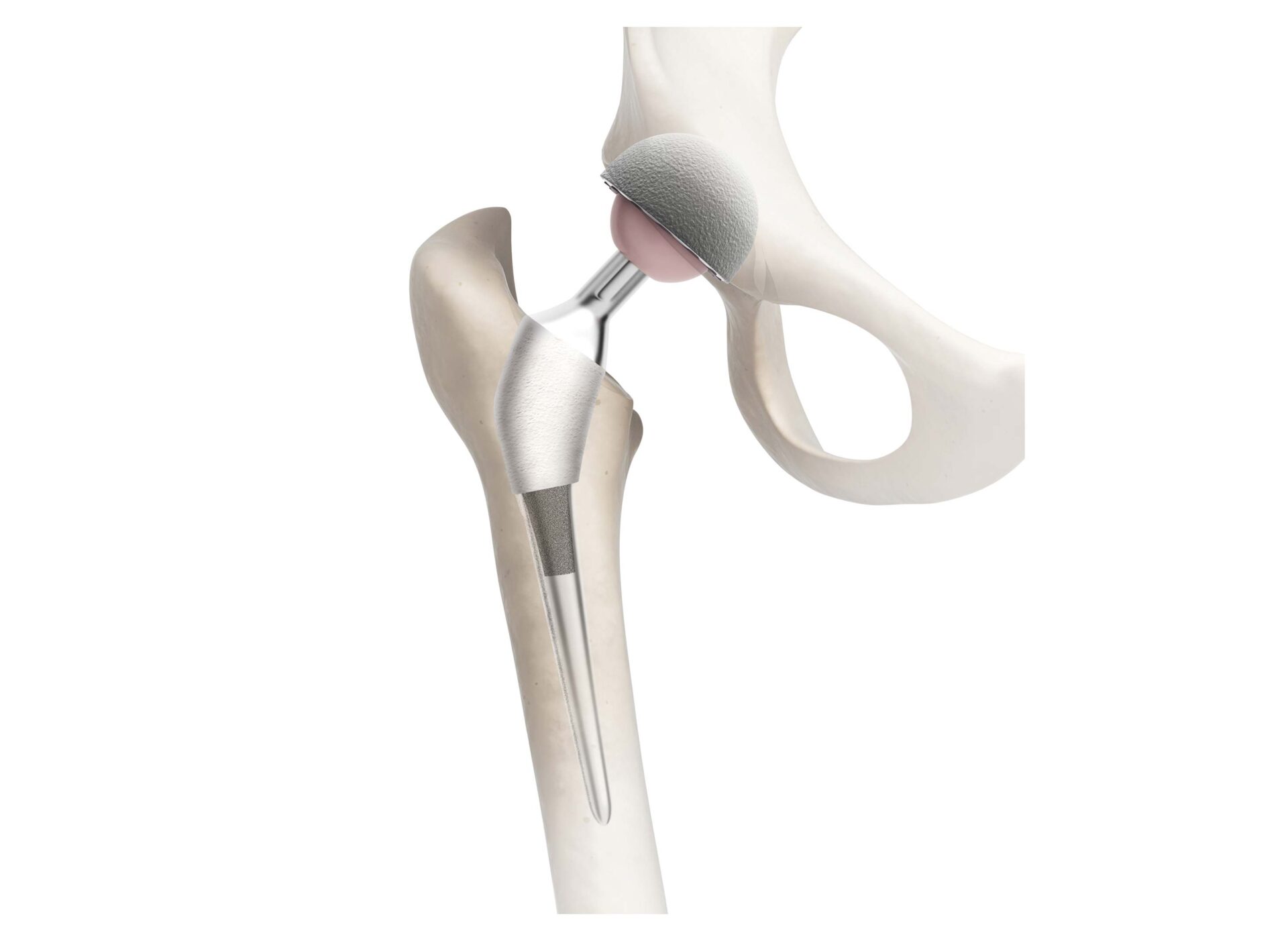 Medical Orthopedic Implant Forgings Market