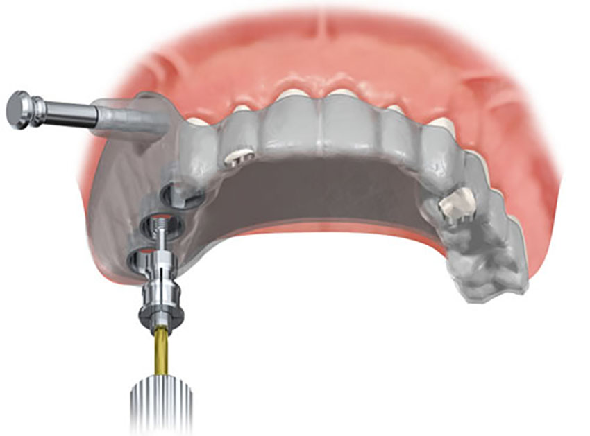 Radial Head Resection Implant Market Consumption Analysis, Business Overview and Upcoming Trends 2032