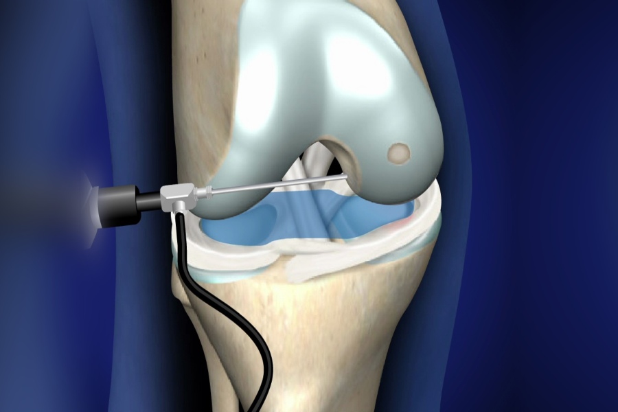 Arthroscopic Resection System Market