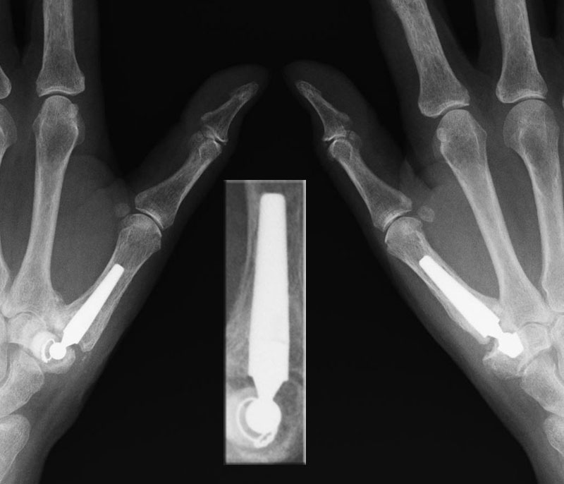 Metacarpophalangeal Joint Prostheses Market: Trends, Innovations, and Growth Opportunities