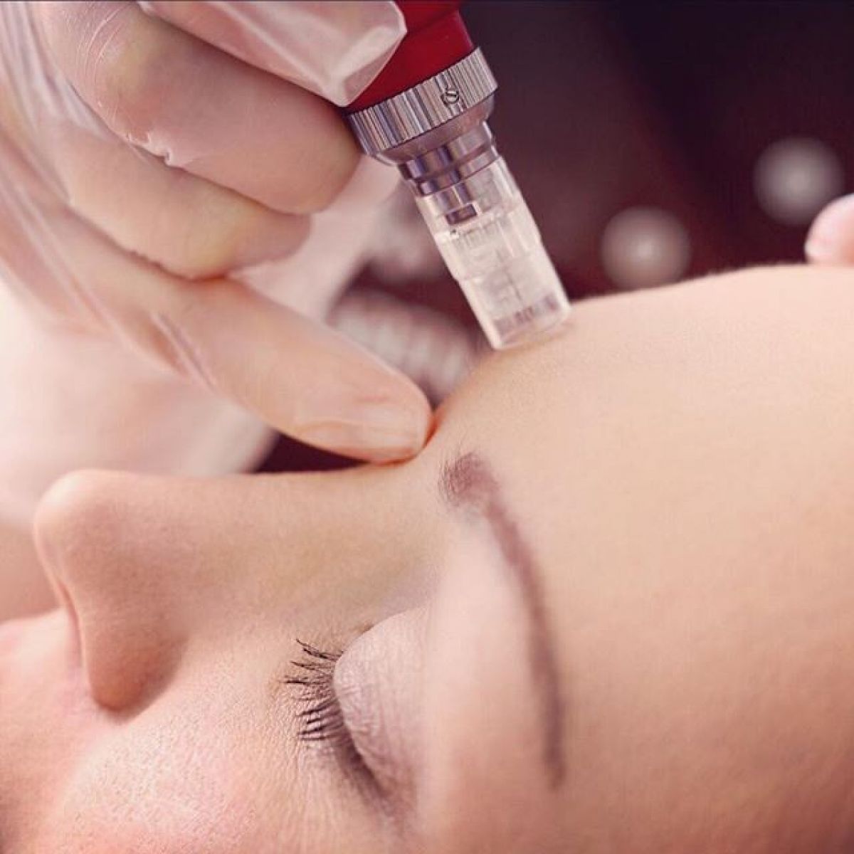 Microniddle Mesotherapy Market