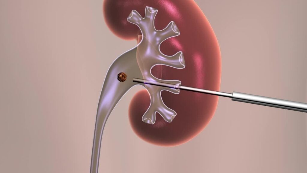 Percutaneous Nephroscope Market