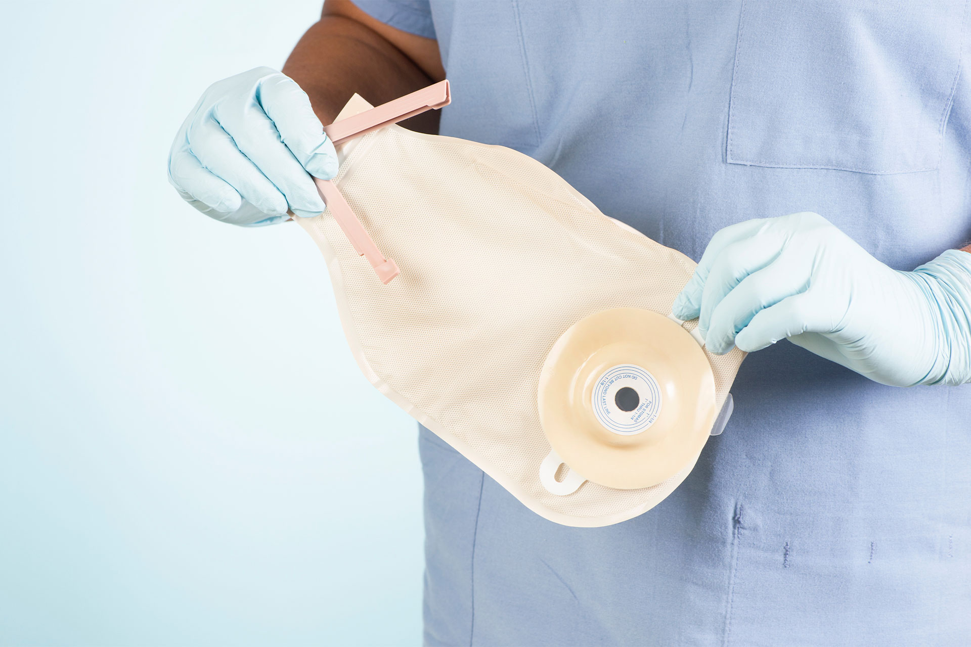 Ileostomy Market Opportunities, Segmentation, Assessment and Competitive Strategies by 2033