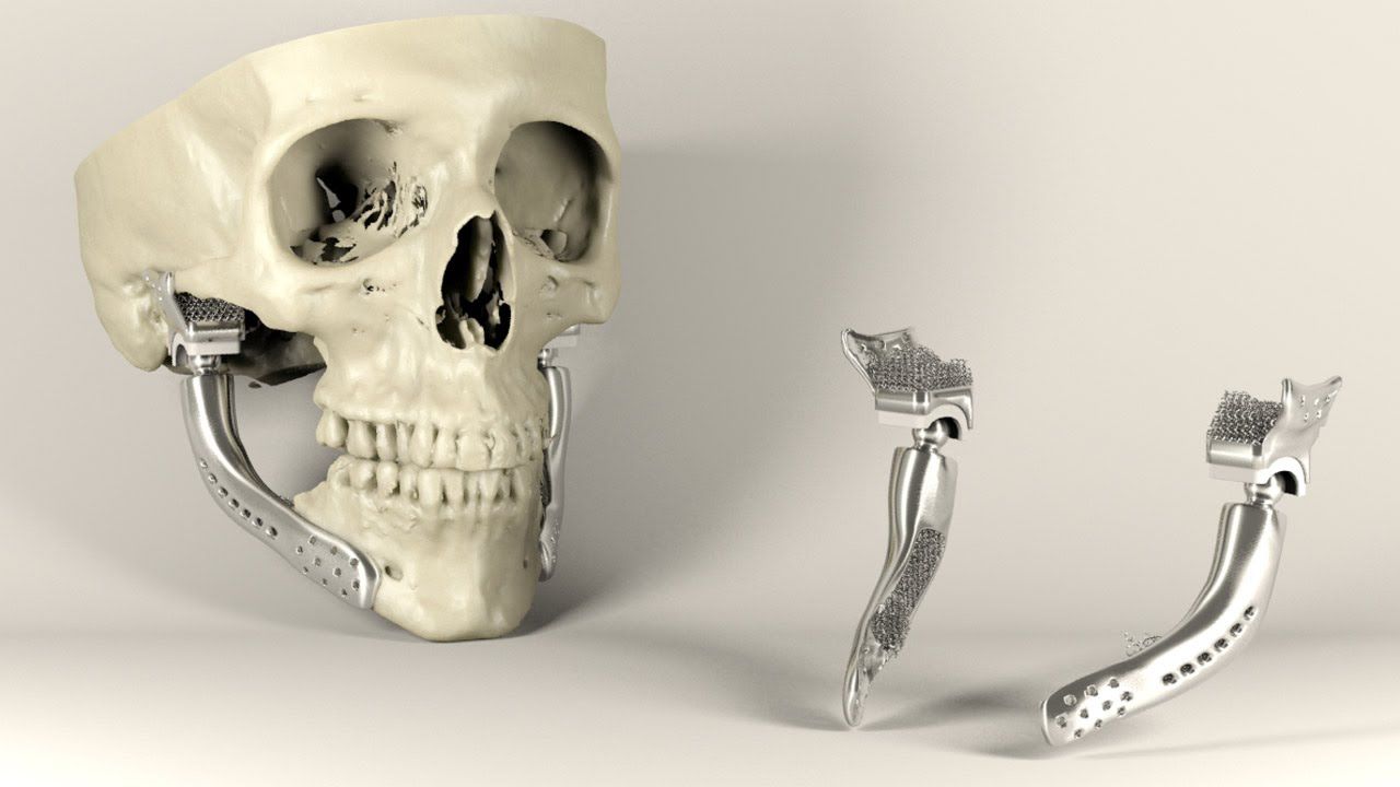 Custom 3D Printed Implants Market
