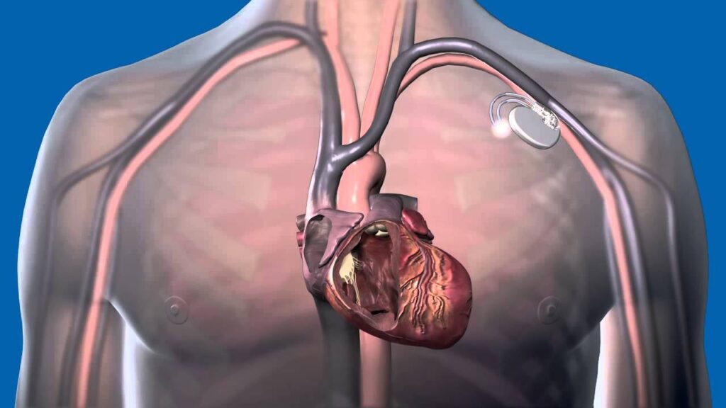 Cardiac Resynchronization Therapy Pacemaker Market