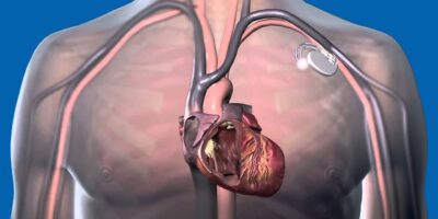Cardiac Resynchronization Therapy Pacemaker Market