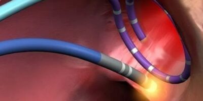 Electrophysiology Ablation Catheters Market