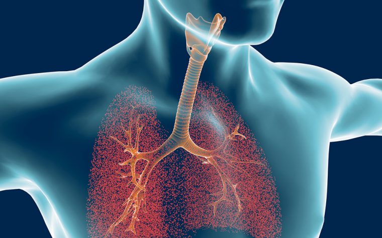 Bronchiectasis Treatment Market