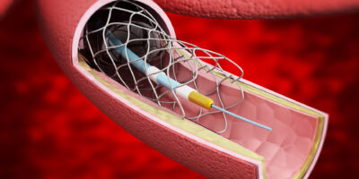 Cardiovascular Prosthetic Devices Market