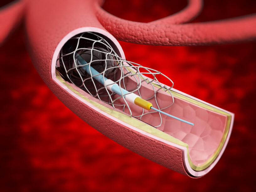 Cardiovascular Prosthetic Devices Market