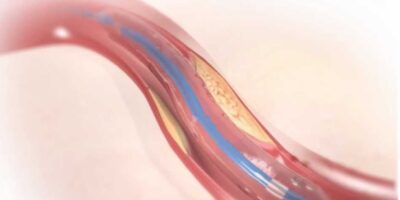 Complex Percutaneous Coronary Intervention Market