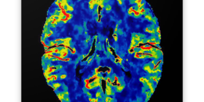 Perfusion Imaging Market