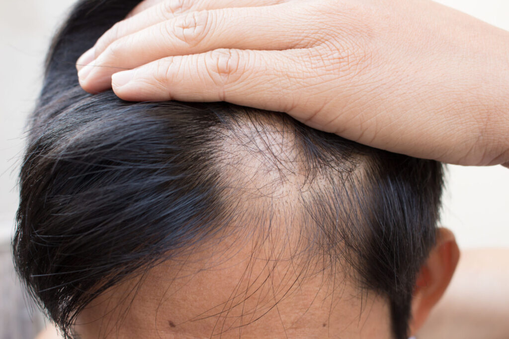 Alopecia (Hair Loss)Treatment Market