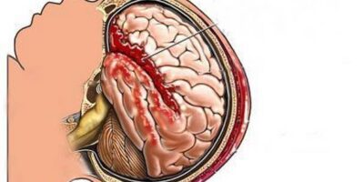 Aneurysmal Subarachnoid Hemorrhage Market