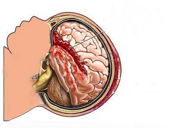 Aneurysmal Subarachnoid Hemorrhage Market