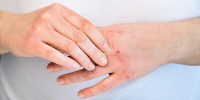 Atopic Dermatitis Treatment Market