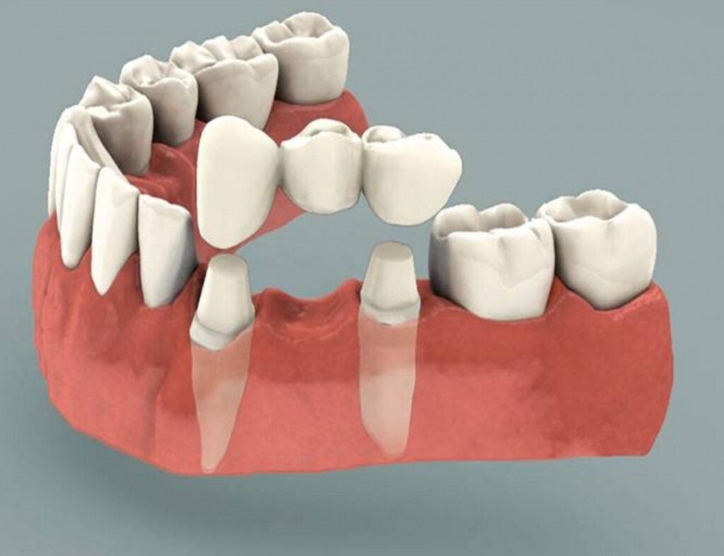 Dental Bridges Market