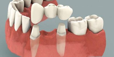 Dental Bridges Market