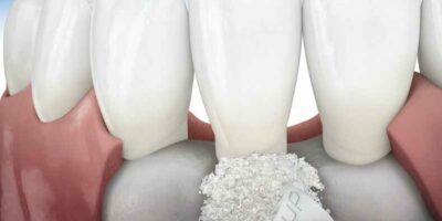 Dental Membrane Market