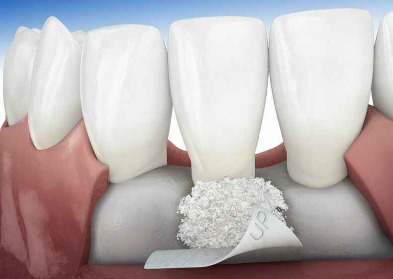 Dental Membrane Market