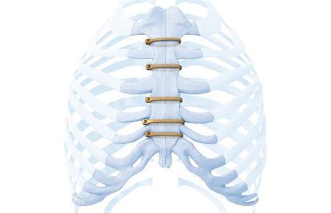 Sternal Closure Systems Market