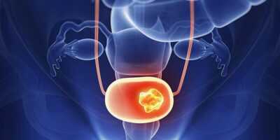 Bladder Cancer Treatment Drugs Market