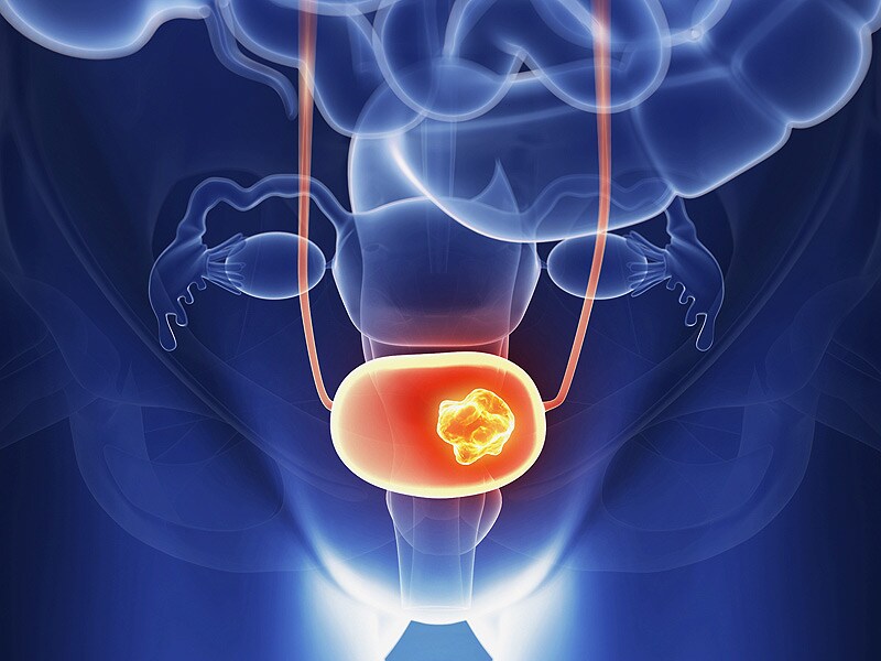 Bladder Cancer Treatment Drugs Market