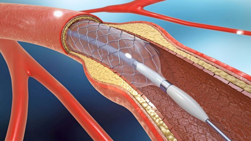 Peripheral Intervention Devices Market